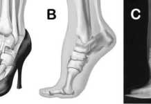 Ekspertët paralajmërojnë: Takat e larta mund të ndryshojnë formën e këmbës dhe të shkaktojnë probleme afatgjata