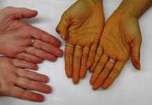 Si mund të tregojnë duart funksionin e tiroides dhe shenjat e hipotiroidizmit