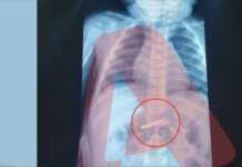 Athinë/Fëmija 3-vjeçar shpëton pasi gëlltiti një brisk rroje